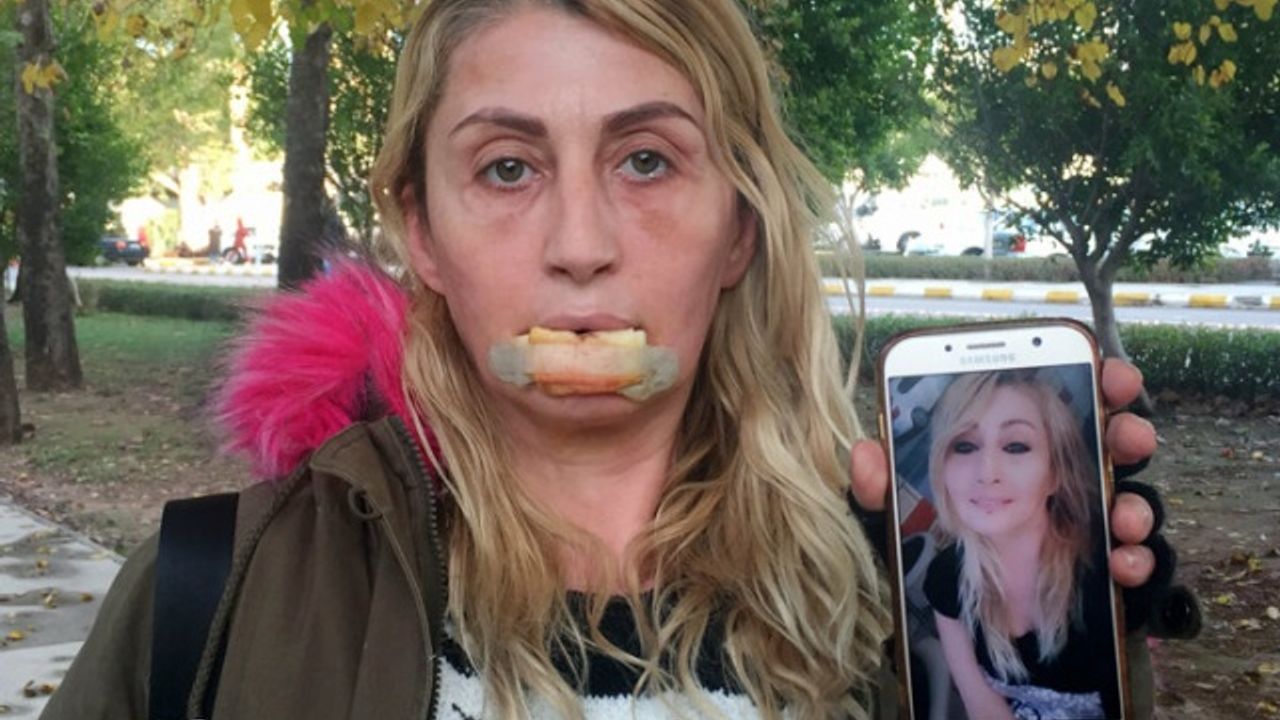 Güzellik uğruna hayatı karardı: Dudağını kaybetti, ağız içi dokuları çürüdü