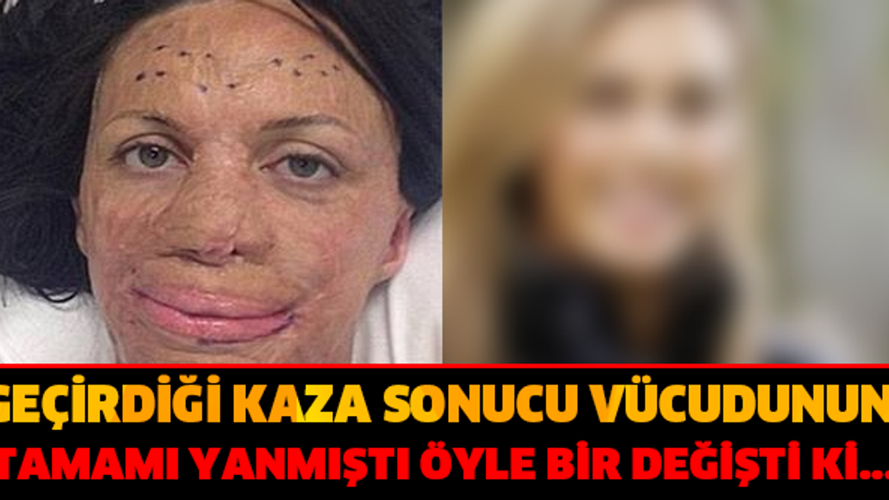 GEÇİRDİĞİ KAZA SONUCU VÜCUDUNUN TAMAMI YANMIŞTI ÖYLE BİR DEĞİŞTİ Kİ... GÖRENLER GÖZLERİNE İNANAMIYOR!!