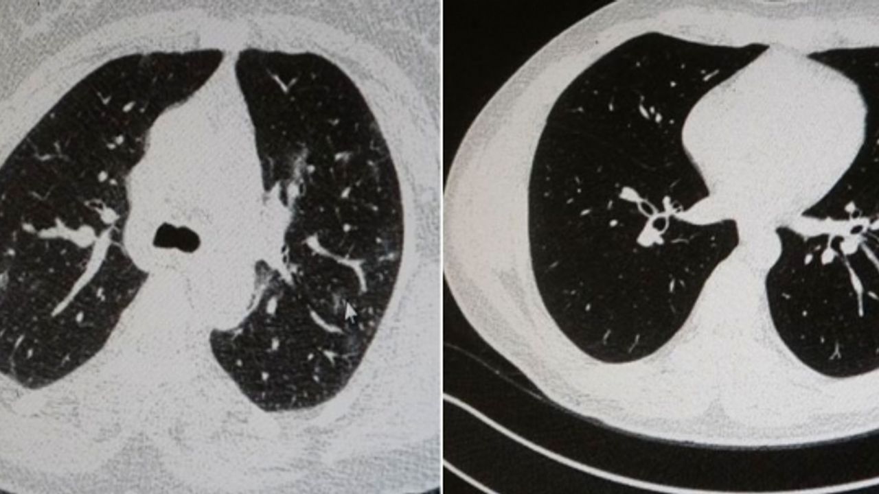 Aşılı ve aşısız olarak koronaya yakalanan 2 gencin akciğer tomografisi arasındaki fark görüntülendi