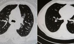 Aşılı ve aşısız olarak koronaya yakalanan 2 gencin akciğer tomografisi arasındaki fark görüntülendi