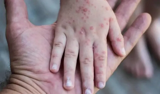 Endonezya'da kızamık salgını: 17 kişi hayatını kaybetti