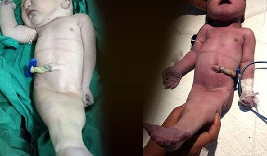 HİNDİSTAN’daki bir devlet hastanesinde ‘denizkızı bebeği’ dünyaya geldi. Her 60 bin/100 bin doğumda bir görülen bu sendromun, Hindistan’da ikinci kez görüldüğü öğrenildi. Bacakları birbirine yapışık olan ve cinsiyeti belirlenemeyen bebeğin doğuma kadar hasta olduğunun fark edilmediği açıklandı.