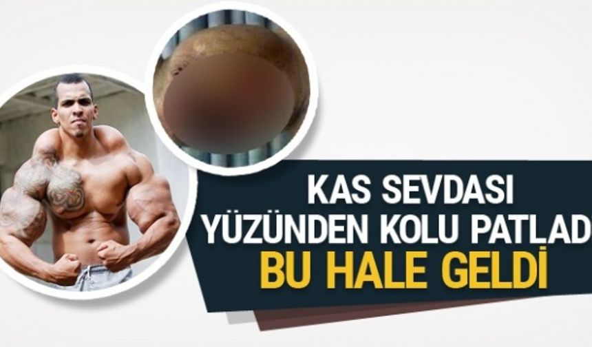 BREZİLYA&#039;da yaşayan 25 yaşındaki Romario Dos Santos Alves, önce yapay kas görüntüsü veren ve şişiren synthol adlı maddeye kullanamaya başladı. Kas yapmasına yaptı ancak az daha kolu patlıyor, kolsuz kalıyordu.